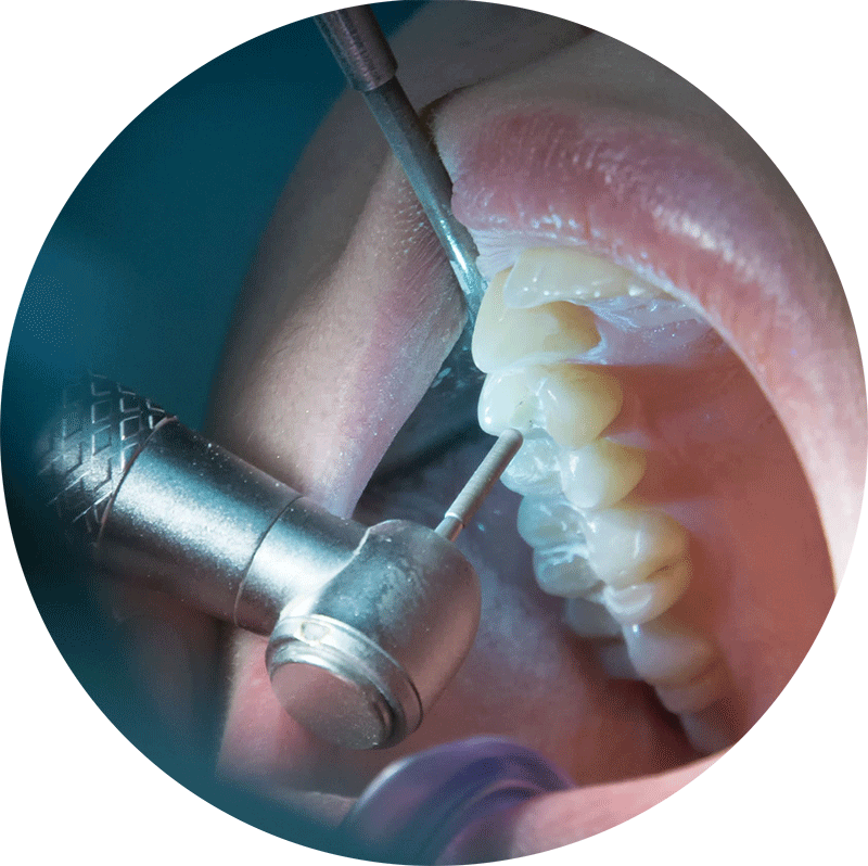 Endodoncia Clinica Trafalgar Badalona